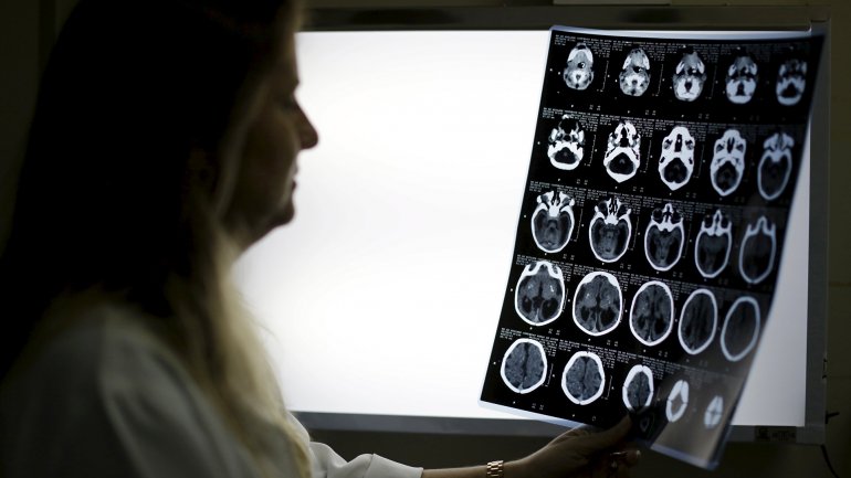Los bebés con microcefalia tienen circunferencia craneal menor a 33 centímetros