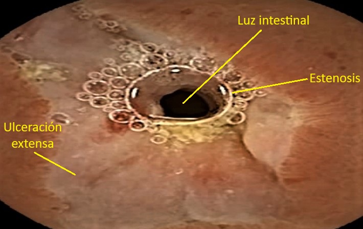 Tubo digestivo: yeyuno, íleon y colon.