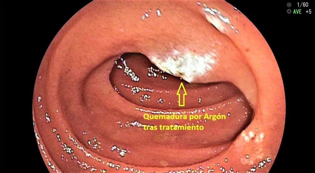 Tubo digestivo: yeyuno, íleon y colon.