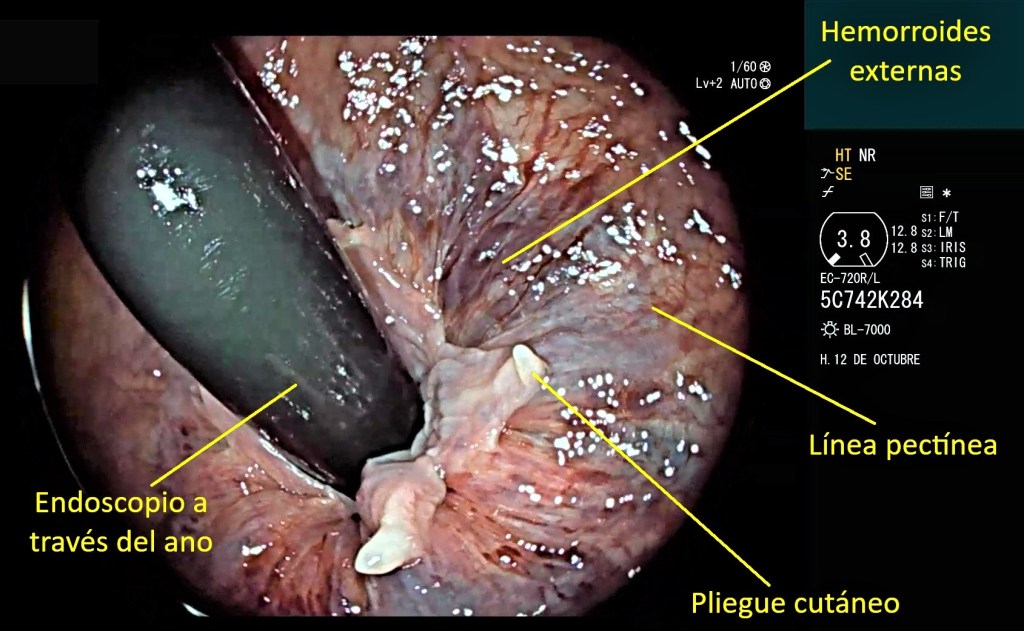 Tubo digestivo: yeyuno, íleon y colon.