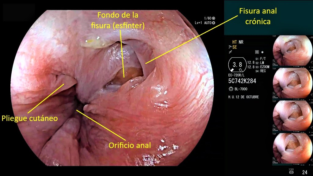 Tubo digestivo: yeyuno, íleon y colon.