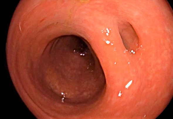 Tubo digestivo: yeyuno, íleon y colon.