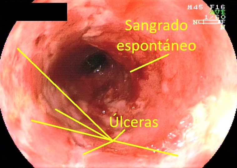 Tubo digestivo: yeyuno, íleon y colon.