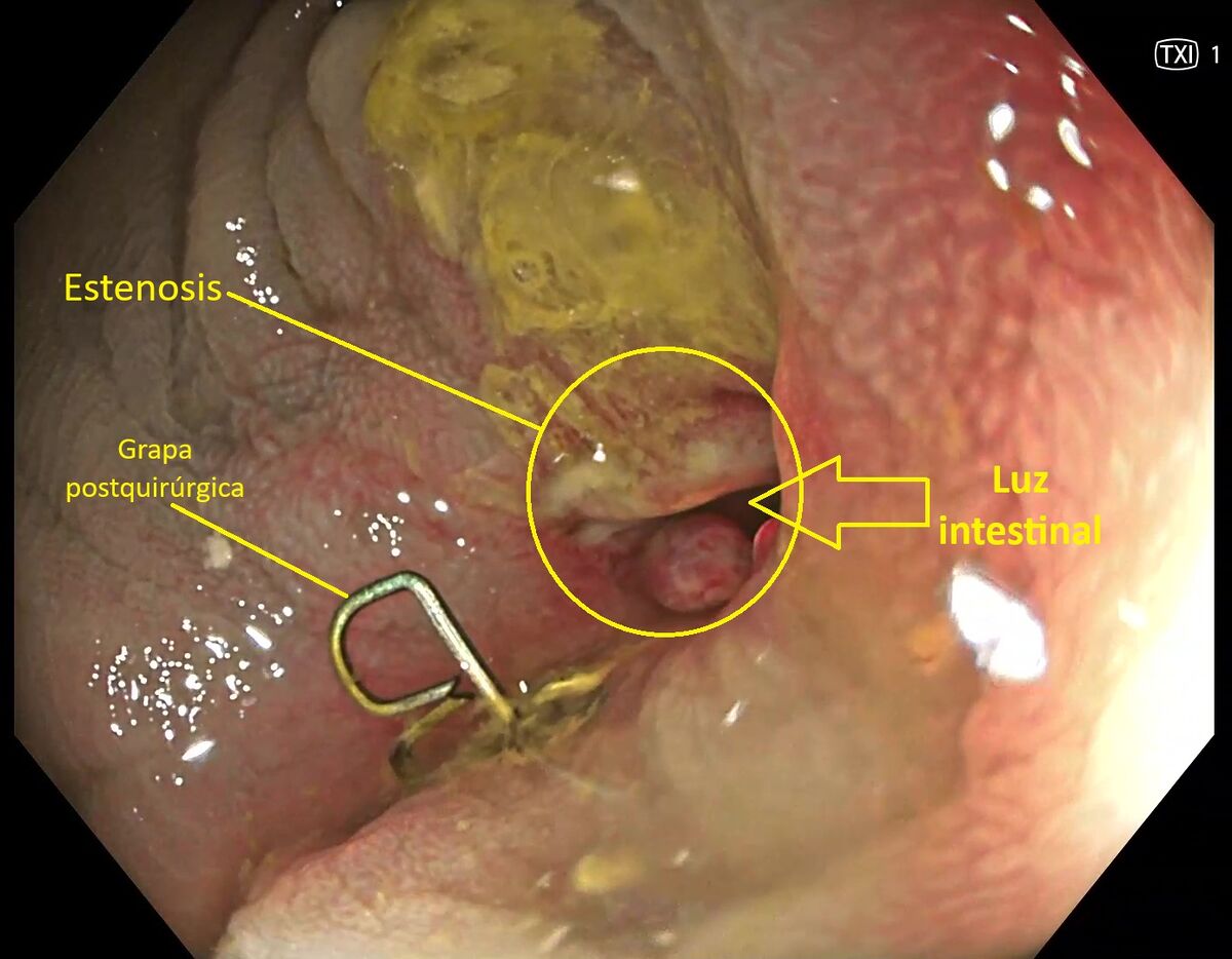 Tubo digestivo: yeyuno, íleon y colon.