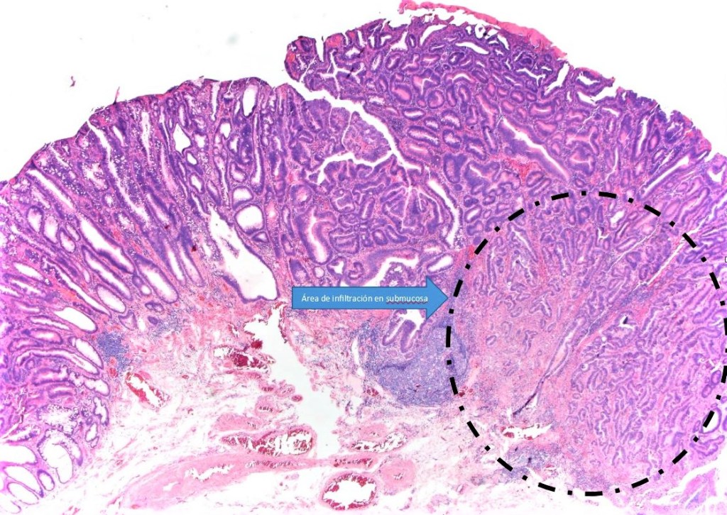 Cáncer analizado por anatomopatología en pólipo de colon.