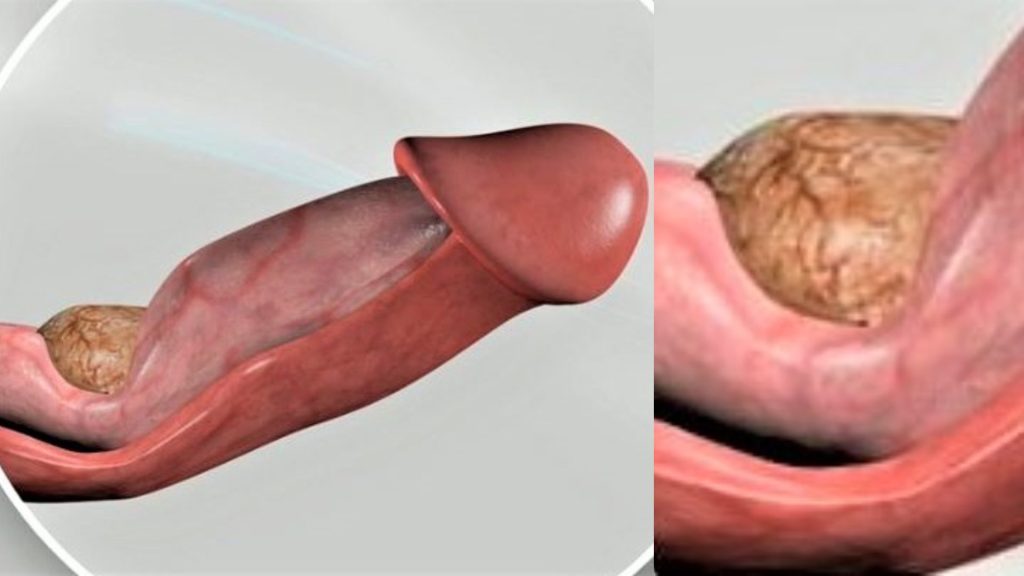 Incurvación del pene.