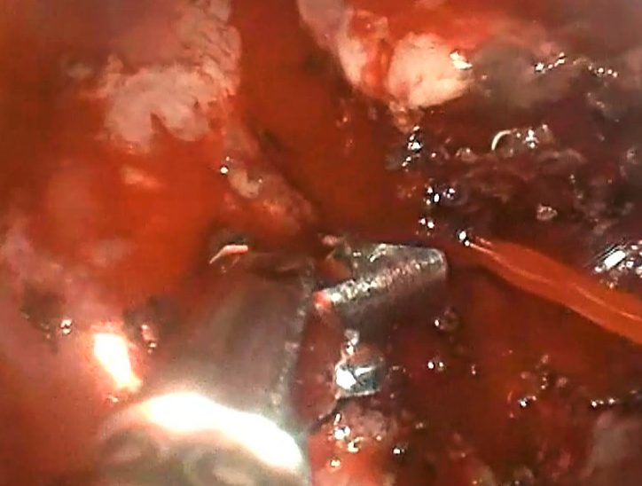 Úlceras gastroduodenales.