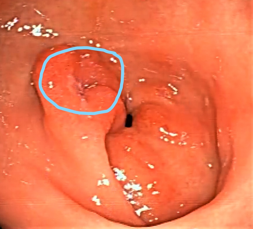 Úlcera antral.
