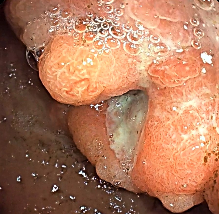 Úlcera gastroduodenal.