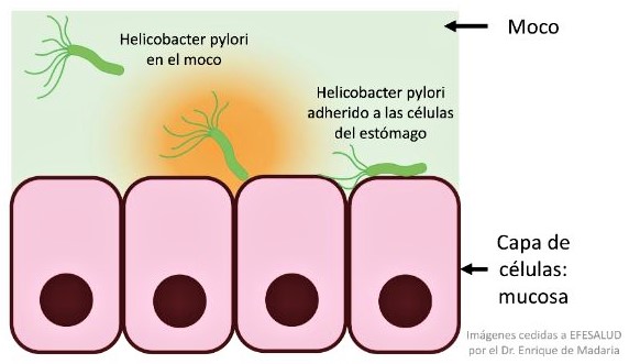úlceras por Helicobacter pylori.