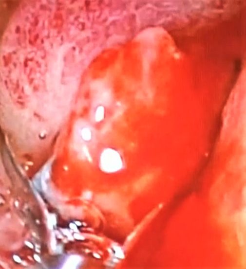 Úlceras gastroduodenales.
