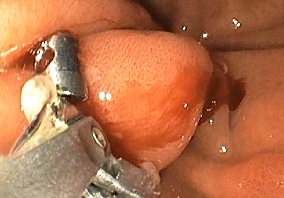 Úlcera gastroduodenal.