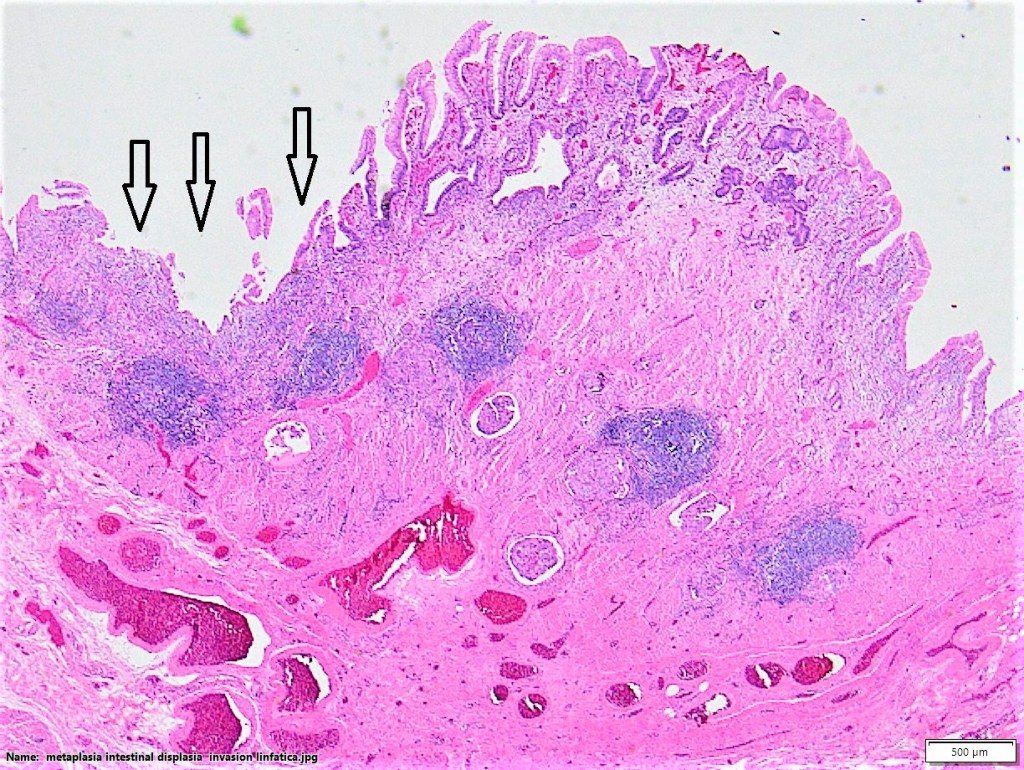 Úlceras gastroduodenales.