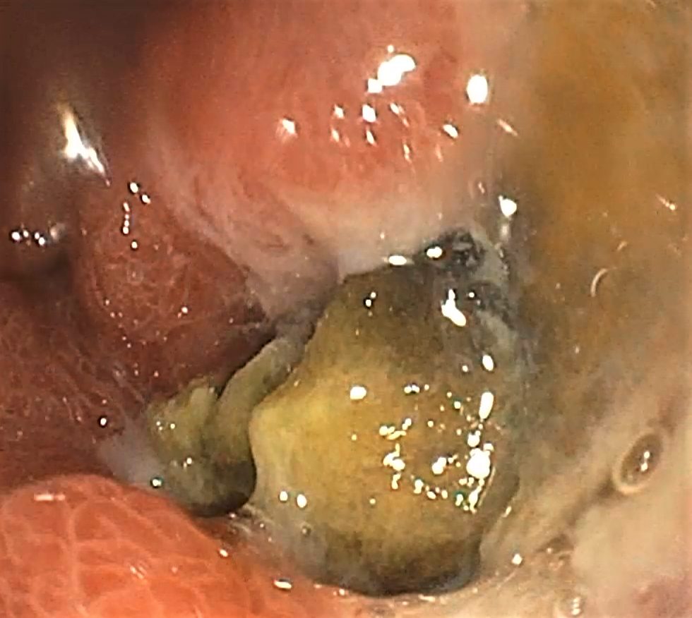 Úlceras gastroduodenales.