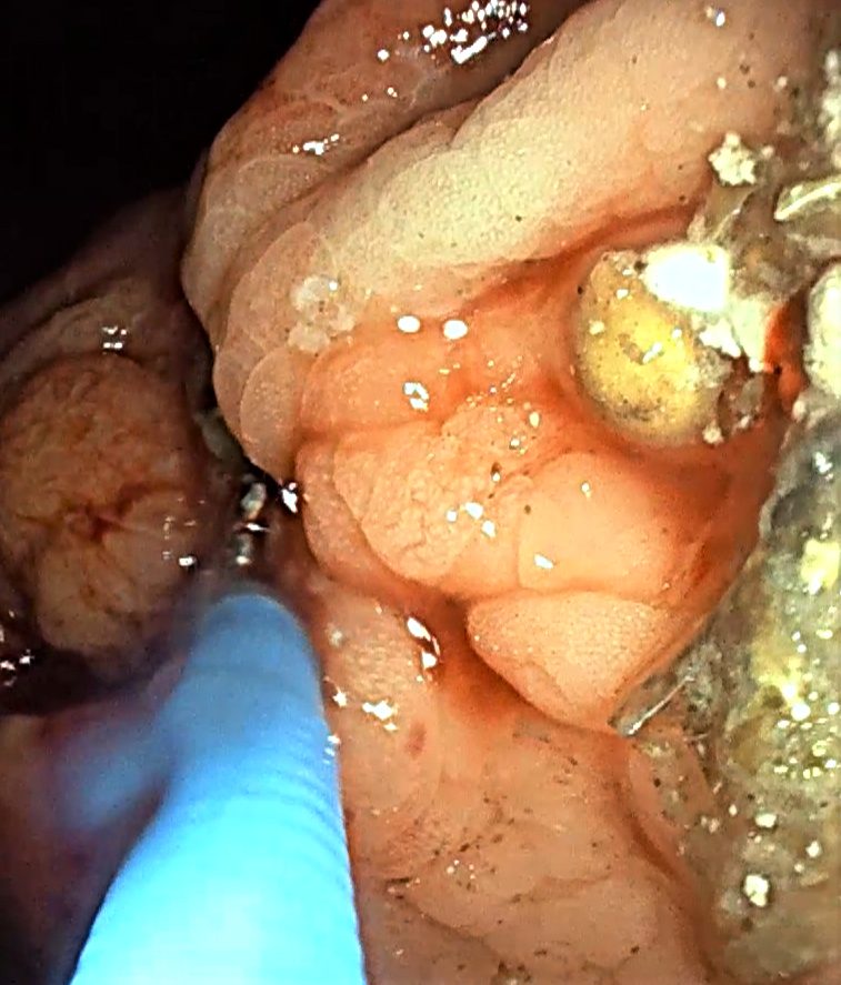 Úlceras gastroduodenales.