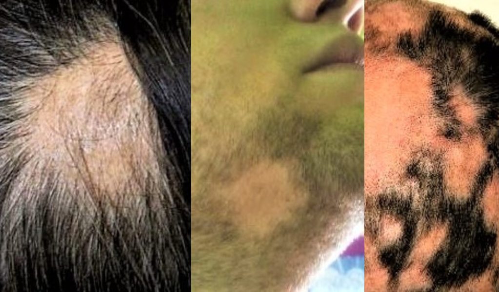 Alopecia areata.