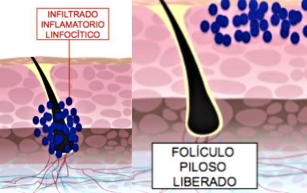 Alopecia areata.