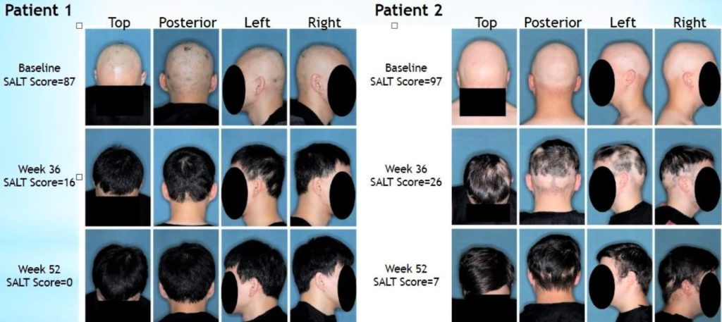 Alopecia areata.