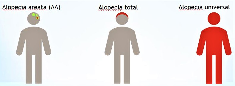 Alopecia areata.
