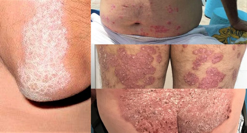 Zonas de la piel con afectación psoriásica.