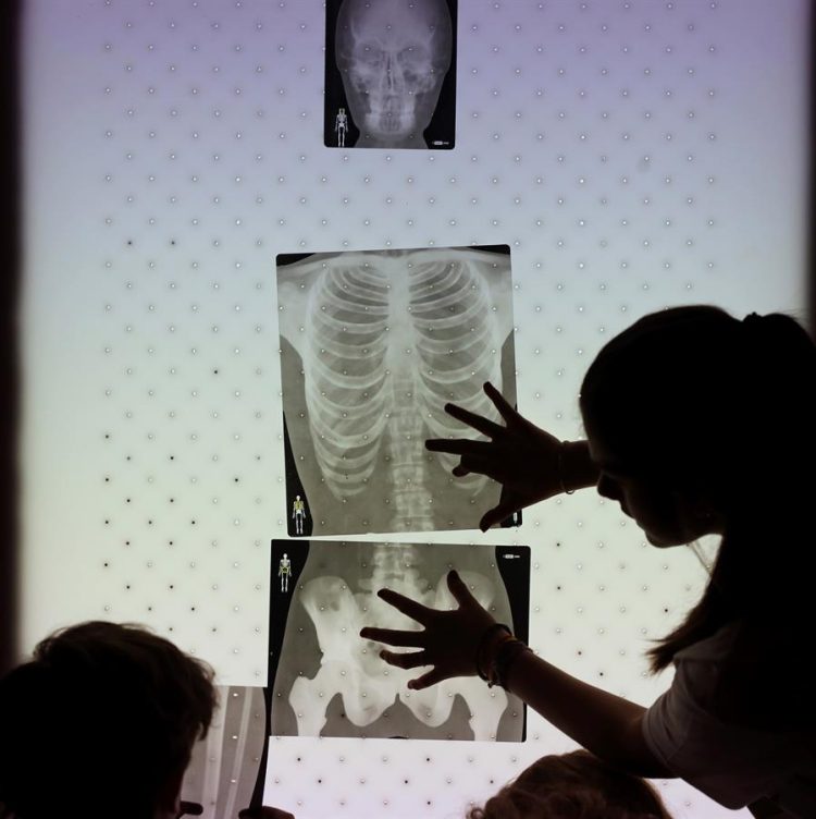 sarcoma Ewing radiografía prevención