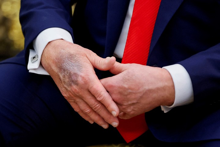 Un visible moretón en la mano derecha de Donald Trump, en una imagen de agosto. Foto: REUTERS  