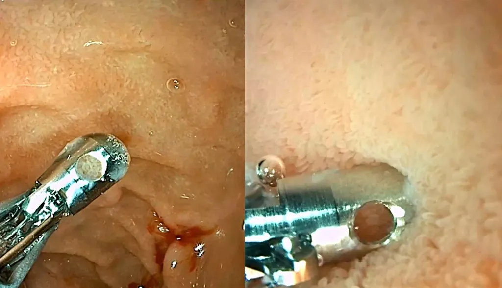 Enfermedad celíaca.