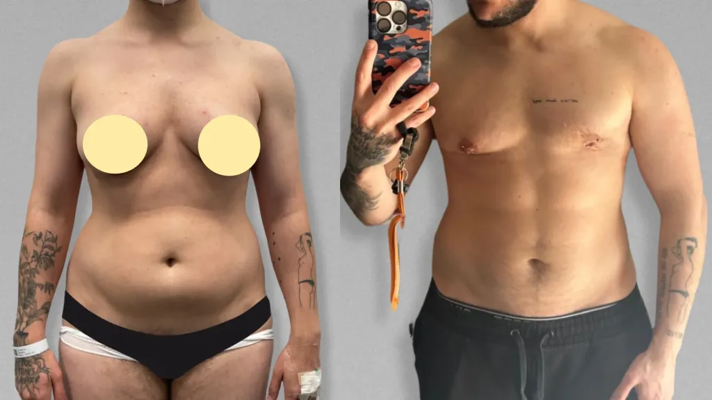 masculinización corporal con cirugía ante la disforia de género.