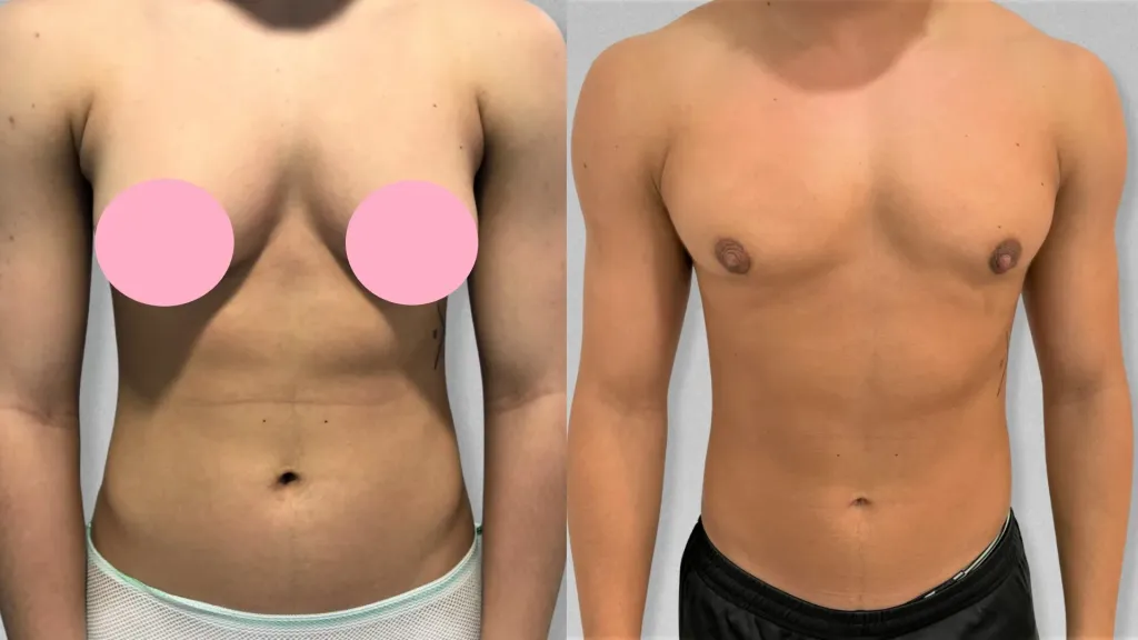 Lipoescultura total.