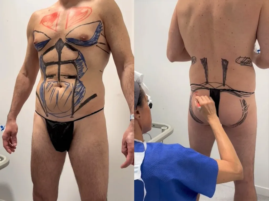 cirugía de lipoescultura.