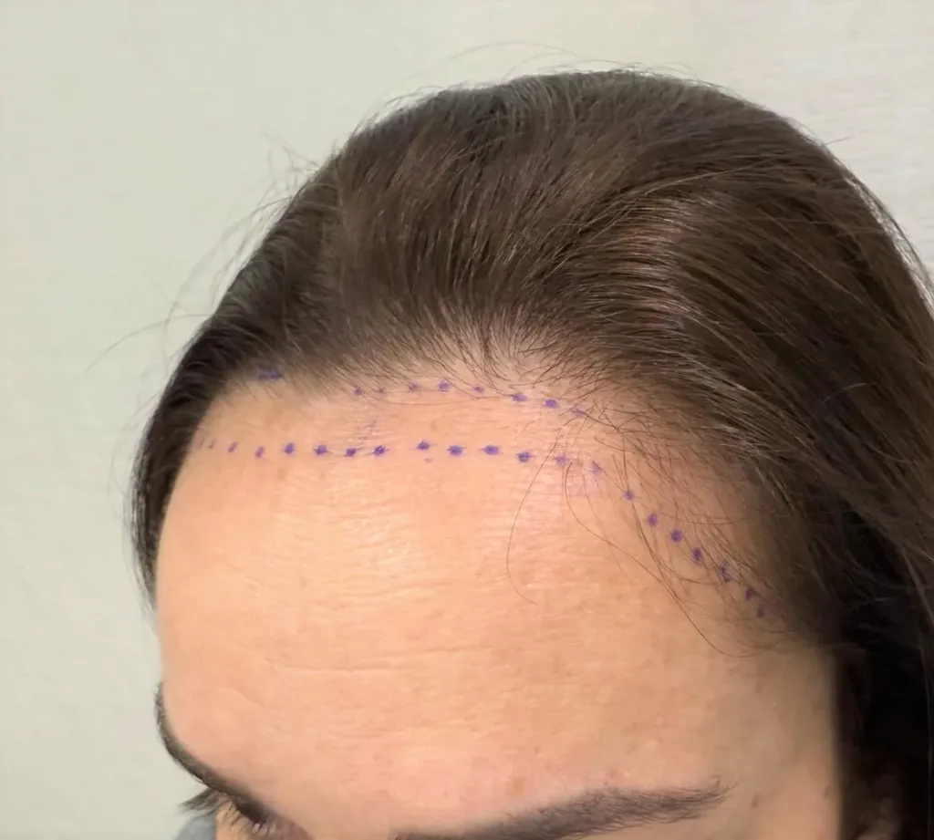 alopecia frontal fibrosante.