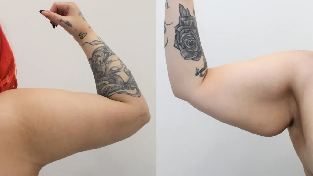 Cirugía de lipedema en brazos.